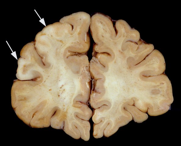 2A2 Tuberous Sclerosis (Case 2) 5a