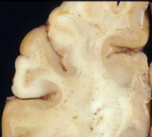 2A3 Tuberous Sclerosis (Case 2) 3a