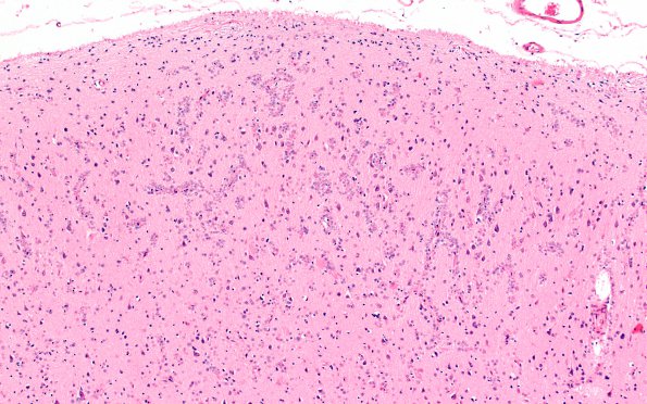 2B1 Tuberous sclerosis (Case 2) H&E corpora amylacea 1