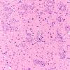 2B2 Tuberous sclerosis (Case 2) H&E corpora amylacea 1 (2)