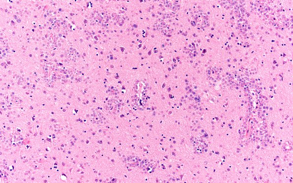 2B2 Tuberous sclerosis (Case 2) H&E corpora amylacea 1 (2)