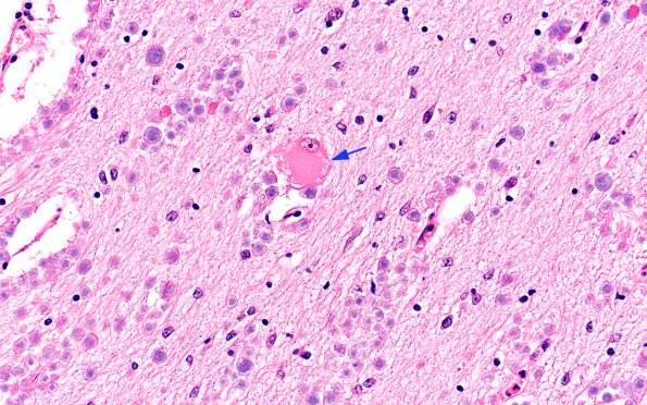 2B3 Tuberous sclerosis (Case 2) H&E corpora amylacea 1