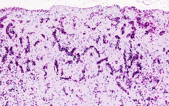 2B4 Tuberous sclerosis (Case 2) PAS corpora amylacea 1