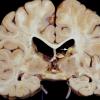 2C1 Tuberous sclerosis (Case 2) 53d