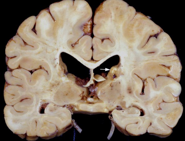 2C1 Tuberous sclerosis (Case 2) 53d