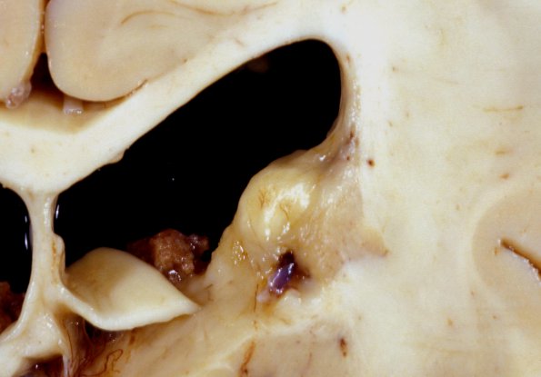 2C2 Tuberous sclerosis (Case 2) 53e