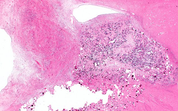 2D1 Tuberous sclerosis (Case 2) H&E 53e