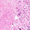 2D2 Tuberous sclerosis (Case 2) H&E 53e