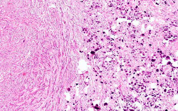 2D2 Tuberous sclerosis (Case 2) H&E 53e