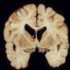 2E1 Tuberous Sclerosis (Case 2) 4a