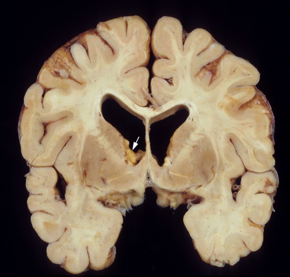 2E1 Tuberous Sclerosis (Case 2) 4a