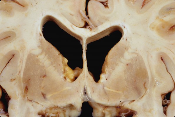 2E2 Tuberous sclerosis (Case 2) 3