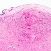 2F1 Tuberous sclerosis (Case 2) 3