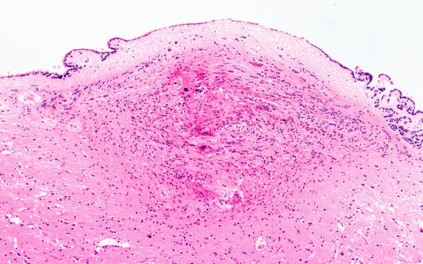 2F1 Tuberous sclerosis (Case 2) 3