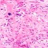 2F2 Tuberous sclerosis (Case 2) 3