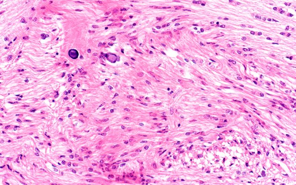 2F2 Tuberous sclerosis (Case 2) 3