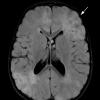 3A1 Tuberous sclerosis (Case 3) Flair 5