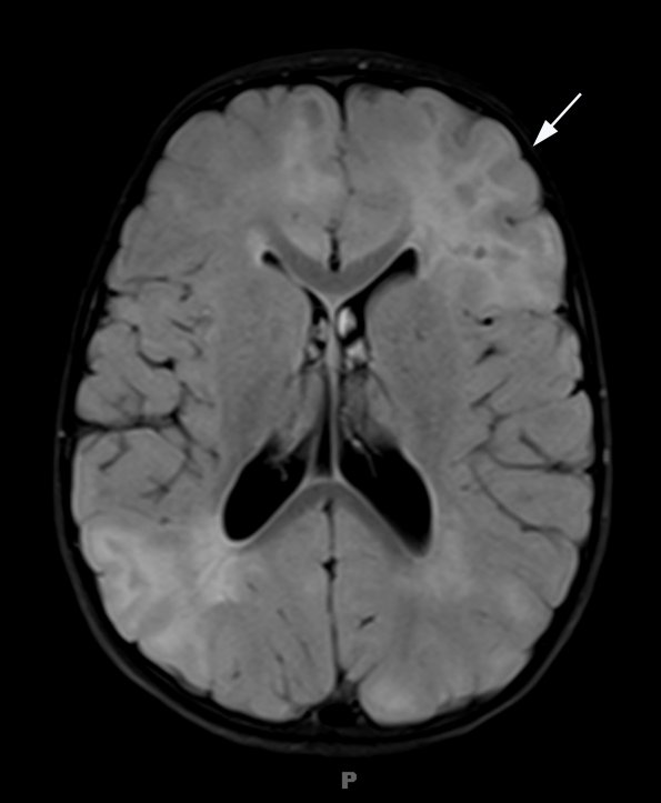 3A1 Tuberous sclerosis (Case 3) Flair 5