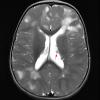 3A2 Tuberous sclerosis (Case 3) T2W 1