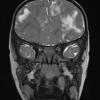 3A3 Tuberous sclerosis (Case 3) T2 1