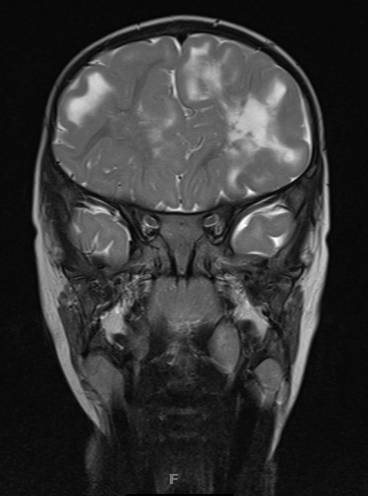 3A3 Tuberous sclerosis (Case 3) T2 1