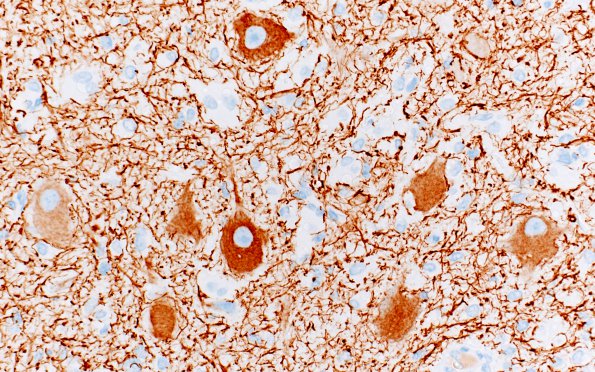 3B2 Tuberous sclerosis (Case 3) A4 NF