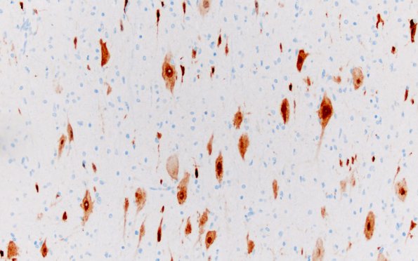 3B3 Tuberous sclerosis (Case 3) A4 NeuN