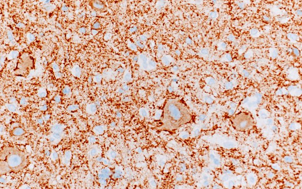 3B4 Tuberous sclerosis (Case 3) SYN