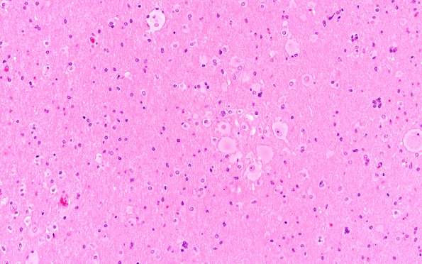 3B6 Tuberous sclerosis (Case 3) A12 WM H&E 1