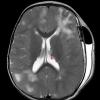 4A Tuberous Sclerosis (Case 4) 2yoT2