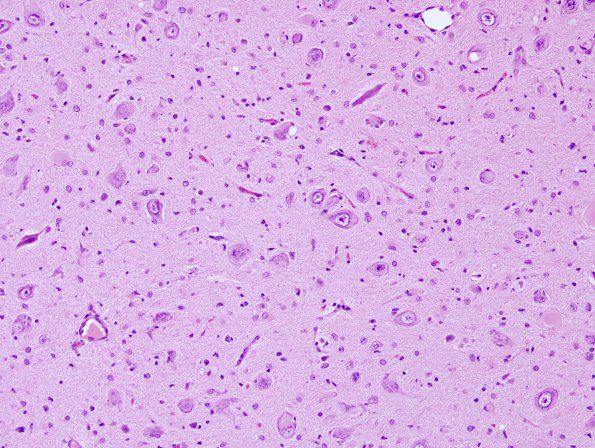 4C Tuberous sclerosis (Case 4) H&E 1