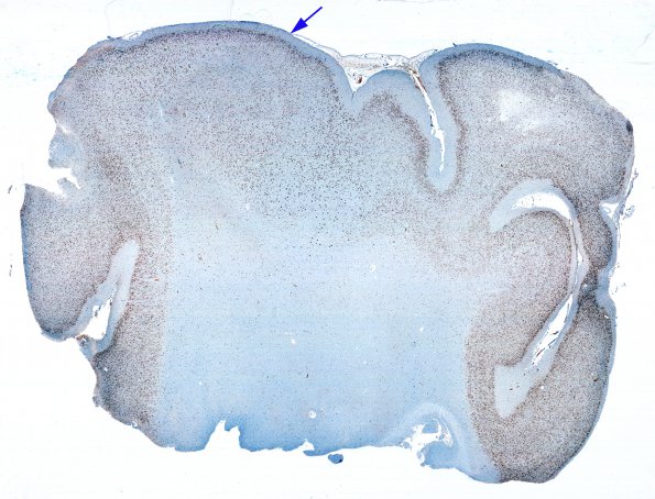 4D1 Tuberous sclerosis (Case 4) NeuN whole mount