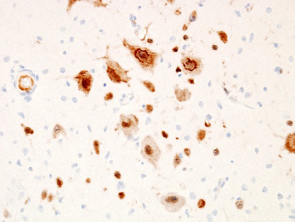 4D3 Tuberous sclerosis (Case 4) NeuN 5A