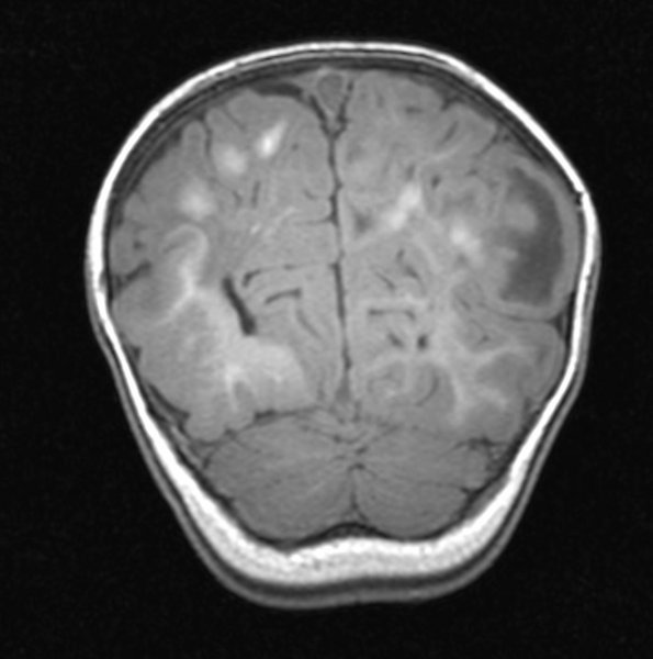 5A1 Tuberous Sclerosis (Case 5) T1 MPRAGE 1