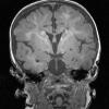 5A2 Tuberous Sclerosis (Case 5) T1 MPRAGE 3