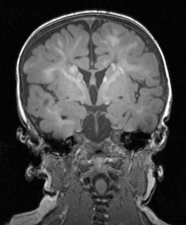 5A2 Tuberous Sclerosis (Case 5) T1 MPRAGE 3