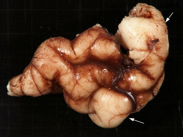 5B1 Tuberous Sclerosis (Case 5) 2