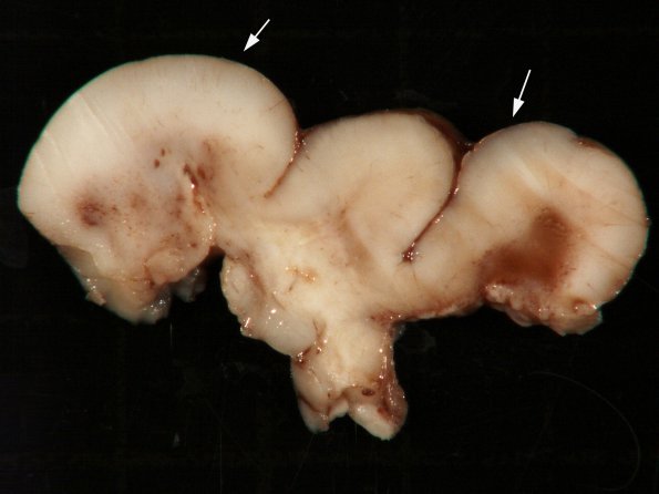 5B2 Tuberous Sclerosis (Case 5) 3