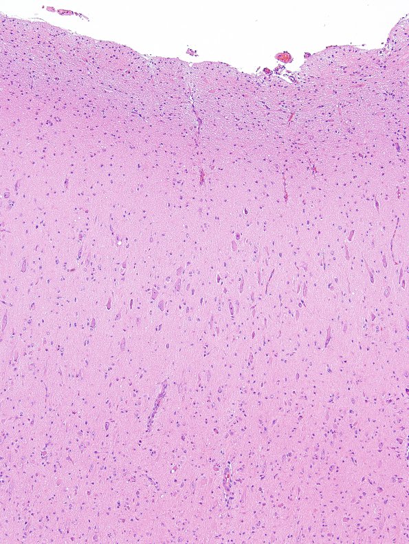 5C2 Tuberous Sclerosis (Case 5) H&E 27