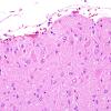 5C3 Tuberous Sclerosis (Case 5) H&E 15