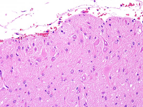 5C3 Tuberous Sclerosis (Case 5) H&E 15