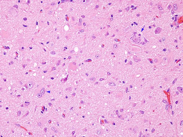 5C4 Tuberous Sclerosis (Case 5) H&E 3