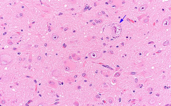 5C5 Tuberous Sclerosis (Case 5) H&E