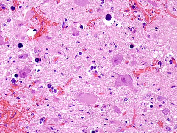 5C6 Tuberous Sclerosis (Case 5) H&E 16