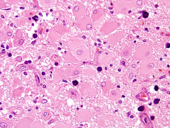 5C7 Tuberous Sclerosis (Case 5) H&E 28