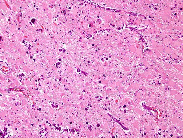 5C8 Tuberous Sclerosis (Case 5) H&E 31