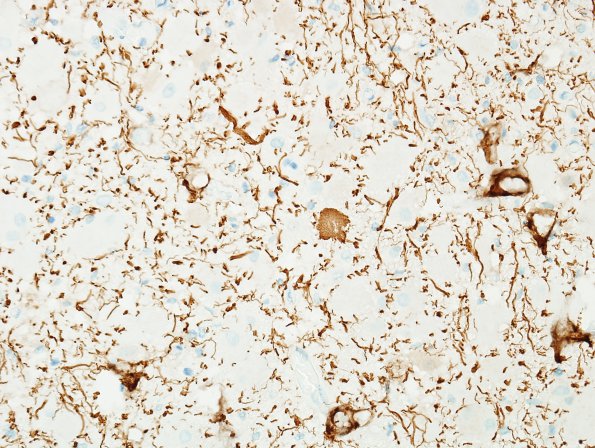 5D4 Tuberous Sclerosis (Case 5) NF 1