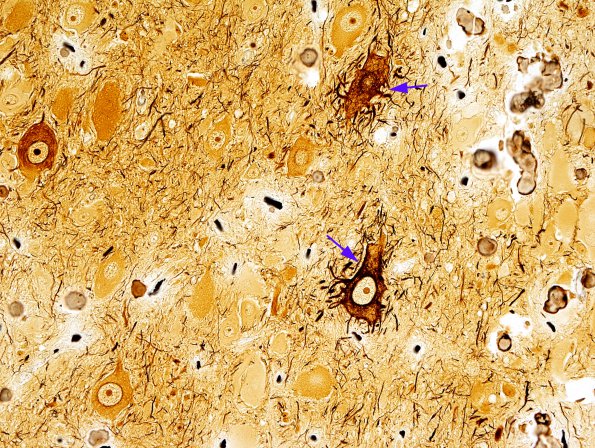 5D5 Tuberous Sclerosis (Case 5) Biels 1