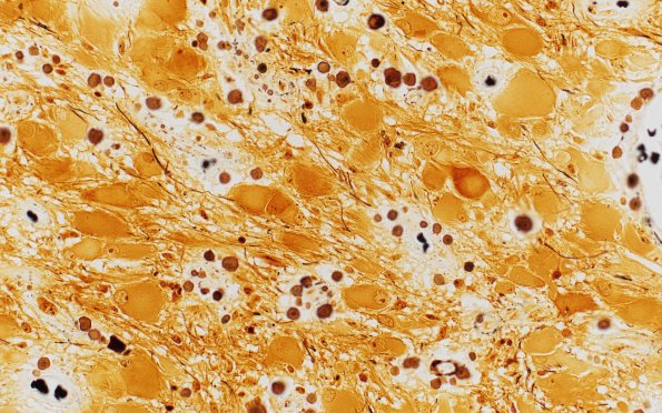 5D6 Tuberous Sclerosis (Case 5) Biels 1