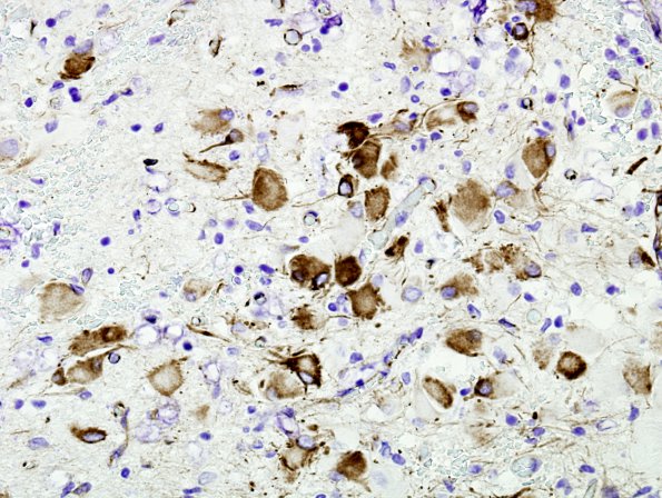 5D7 Tuberous Sclerosis (Case 5) Nestin 8A